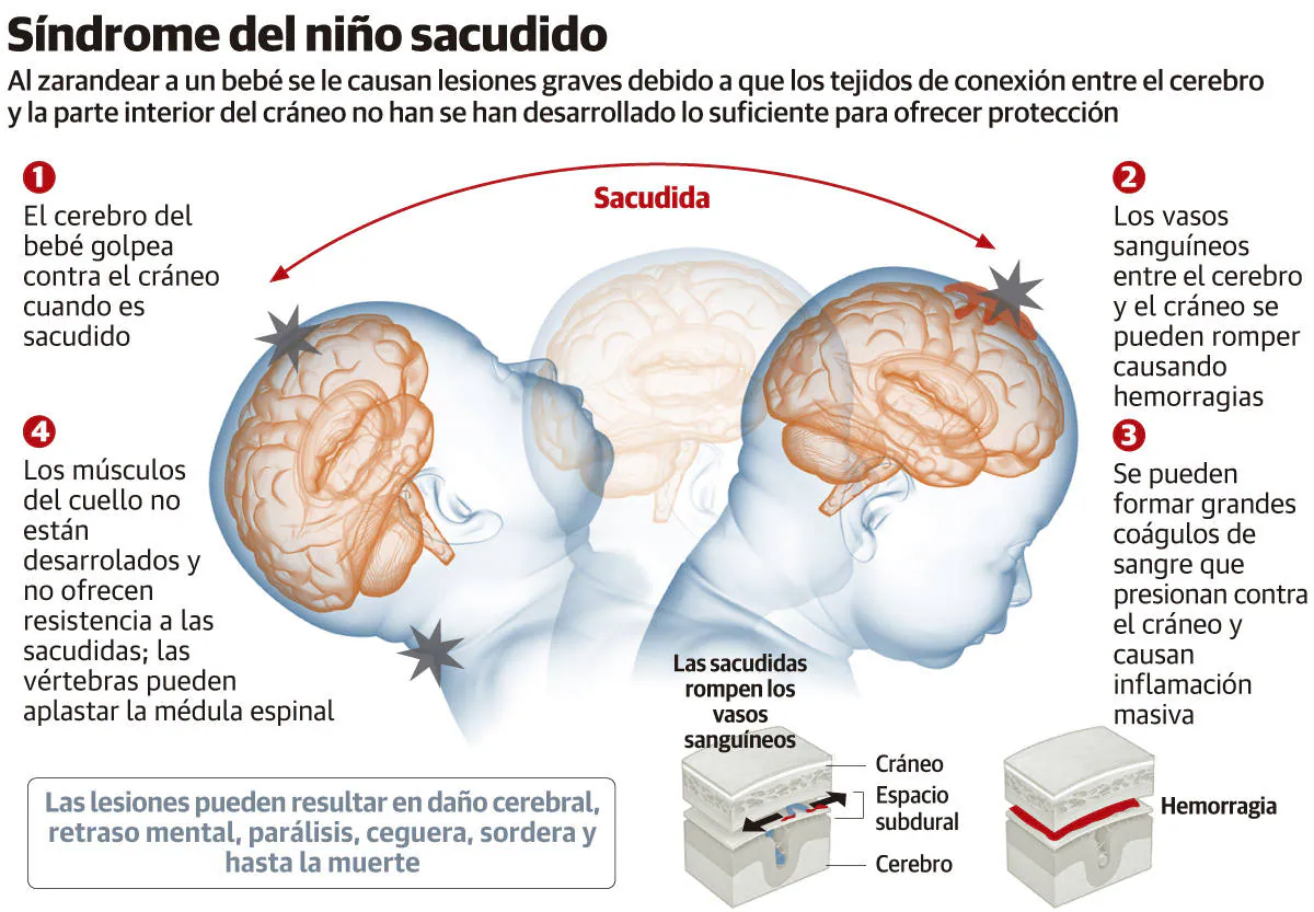 El Zarandeo Al Que Fue Sometido El Bebe Fallecido En Gijon Provoca Lesiones Inmediatas El Comercio